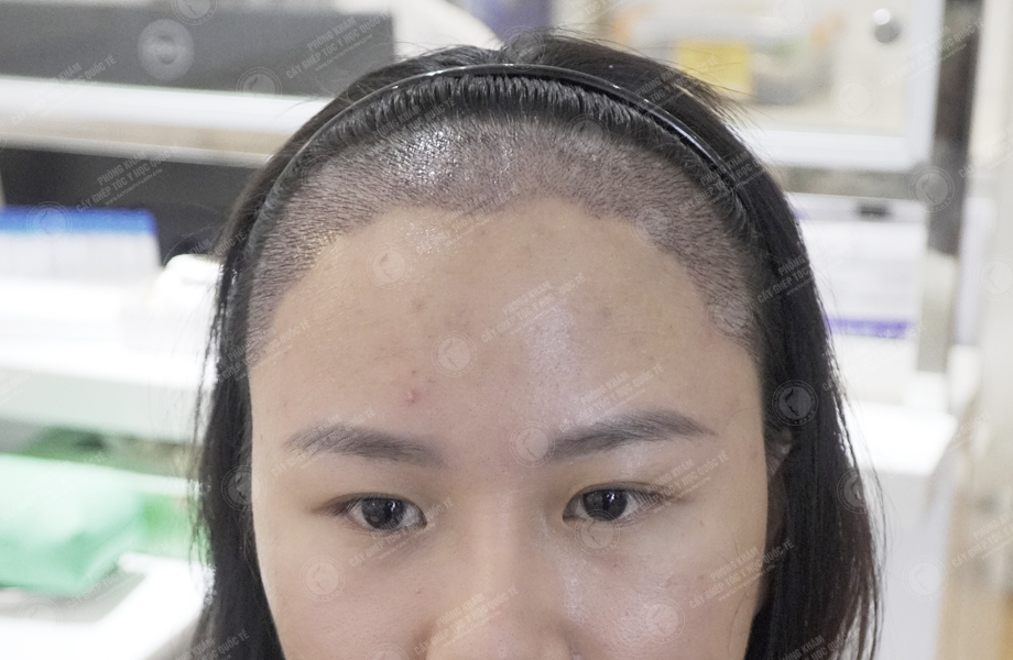 Nguyễn Thị Thúy Hằng - Cấy tóc đường chữ M 5