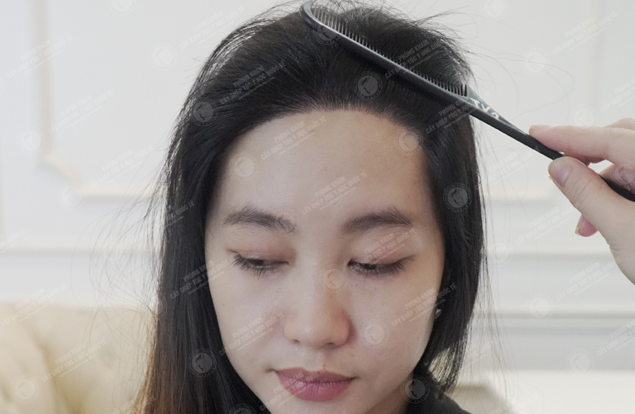 Phạm Thị Kim - Cấy tóc đường chữ M 5