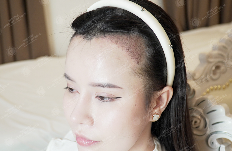 Nguyễn Thị Thảo - Cấy tóc đường chữ M 5