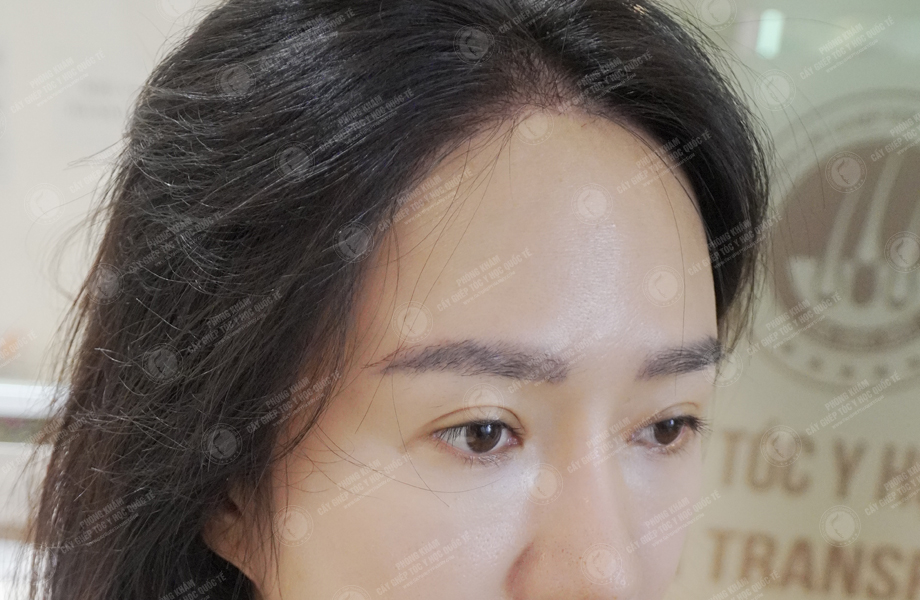 Nguyễn Thảo Phương - Cấy lông mày 6