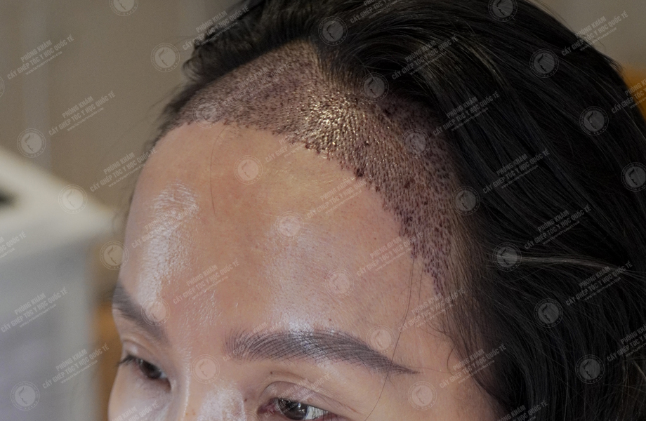 Phan Thị Tuyết - Cấy tóc đường chữ M 6