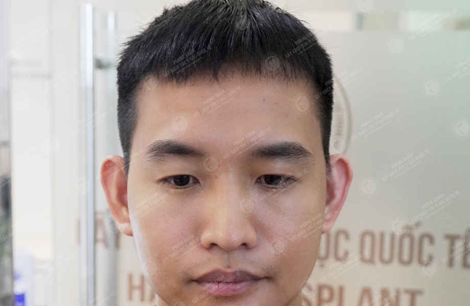 Lê Bá Hiệp - Cấy tóc đường chữ M 6