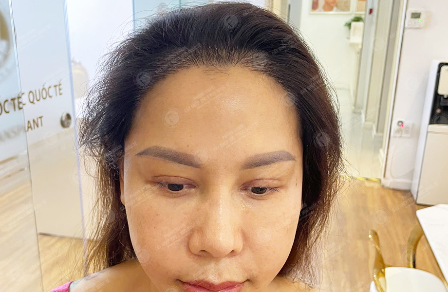 Ngô Thùy Dương - Cấy tóc đường chữ M 6