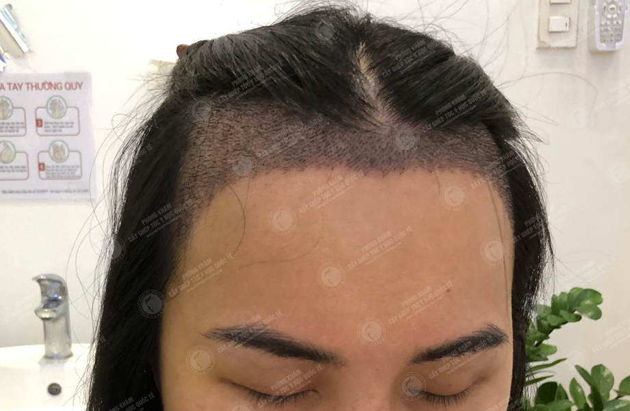 Lê Thanh Thúy - Cấy tóc đường chữ M 6