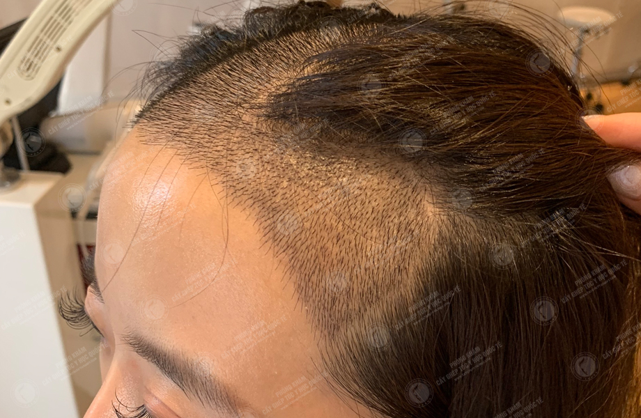 Phạm Thu Nguyệt - Cấy tóc đường chữ M 6