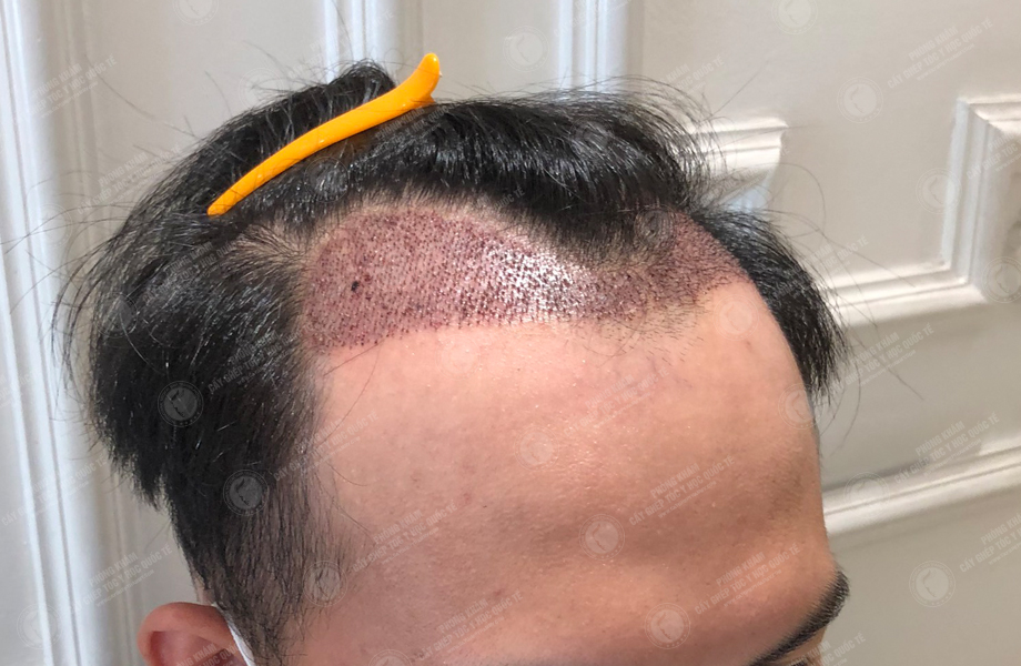 Nguyễn Thành Nam - Cấy tóc đường chữ M 6