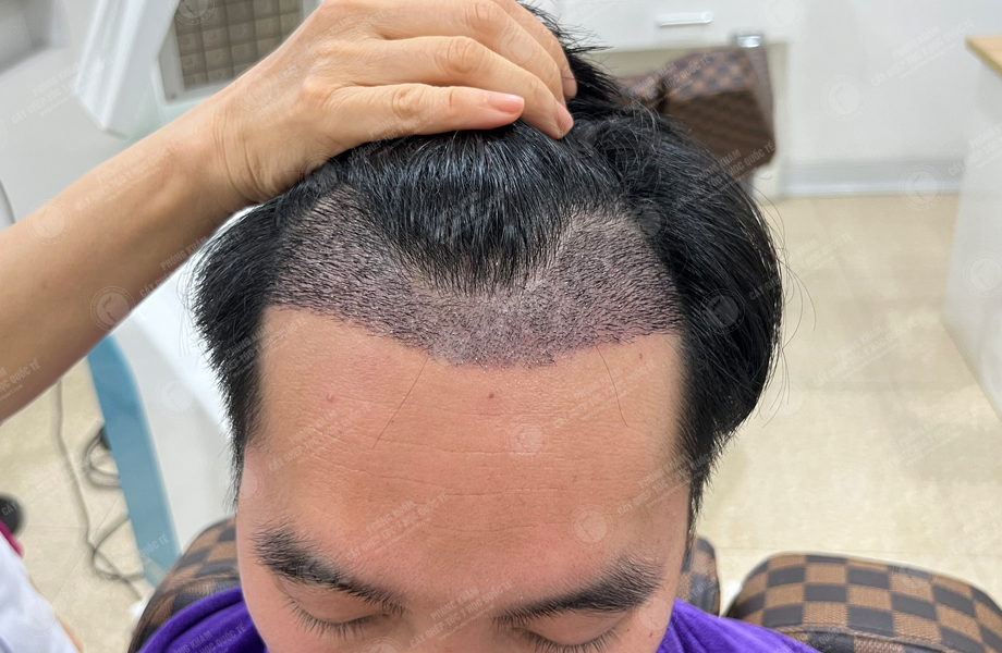 Phạm Trung Tuấn - Cấy tóc đường chữ M 6