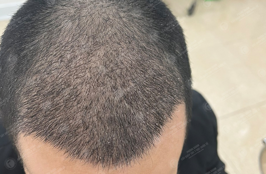 Trần Việt Dũng - Cấy tóc đường chữ M 6
