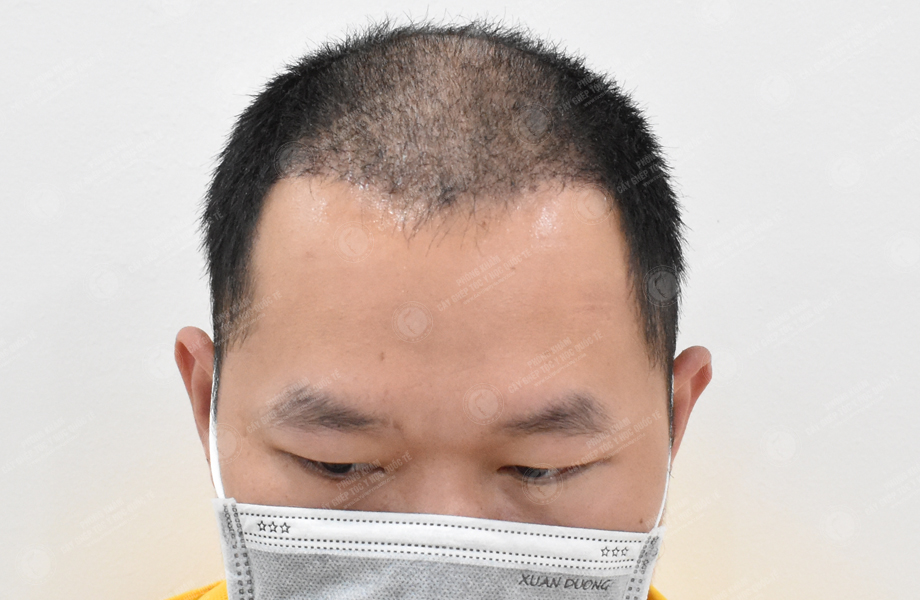 Trần Duy Tâm - Cấy tóc đường chữ M 6