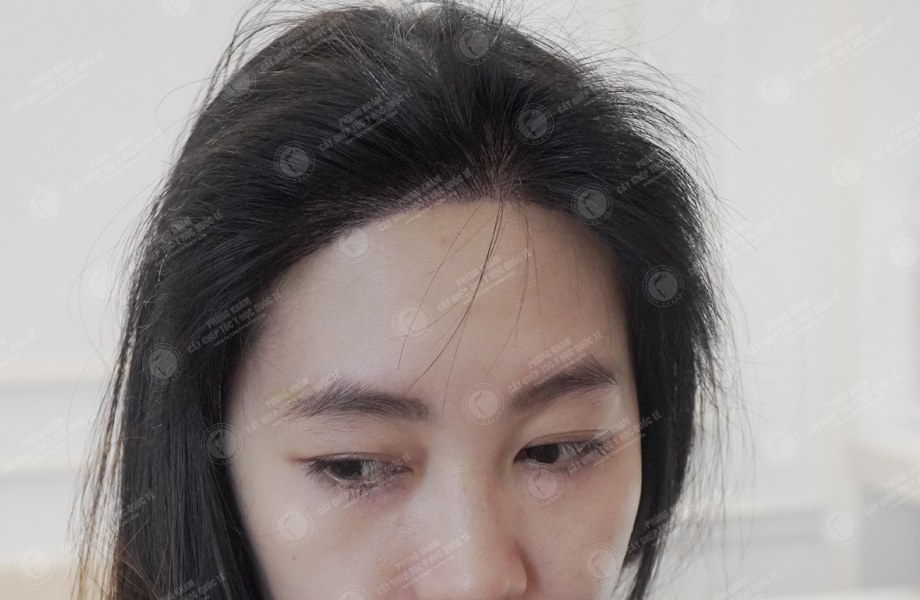 Phạm Thị Kim - Cấy tóc đường chữ M 6