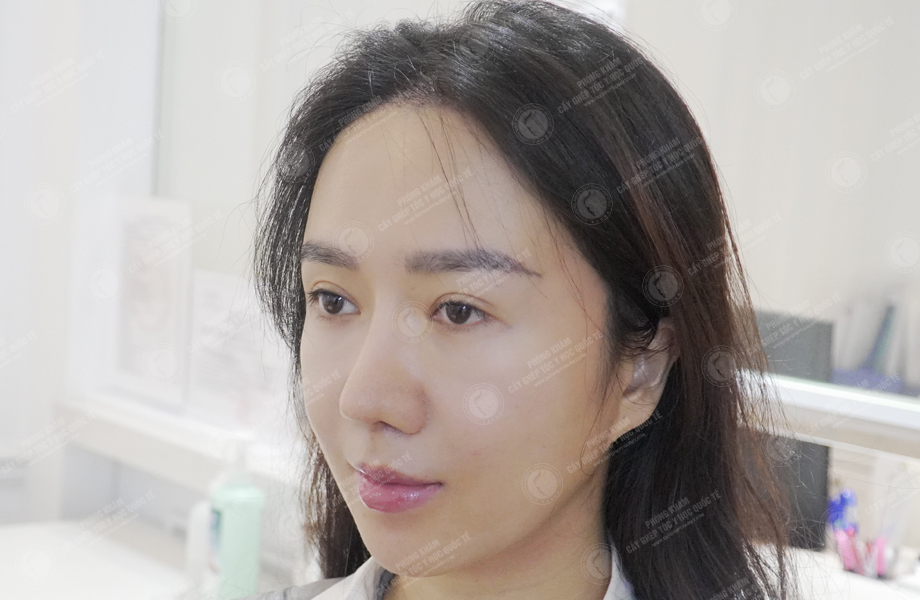 Nguyễn Thảo Phương - Cấy lông mày 7