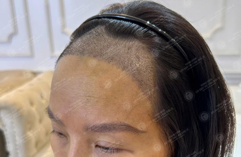 Phan Thị Tuyết - Cấy tóc đường chữ M 7