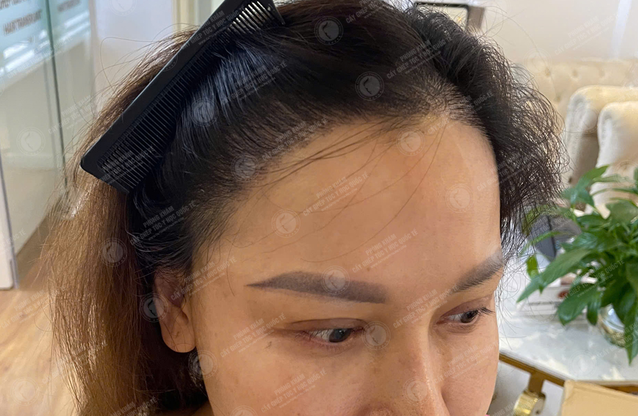 Ngô Thùy Dương - Cấy tóc đường chữ M 7