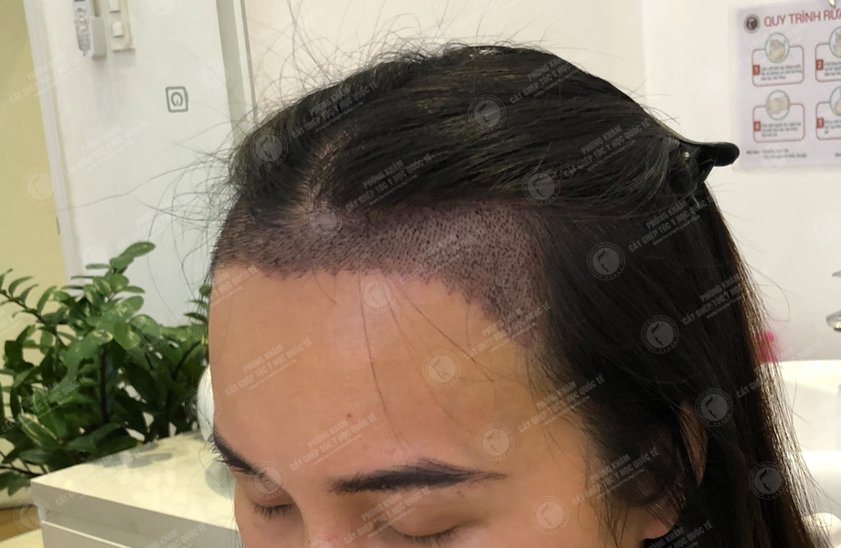Lê Thanh Thúy - Cấy tóc đường chữ M 7