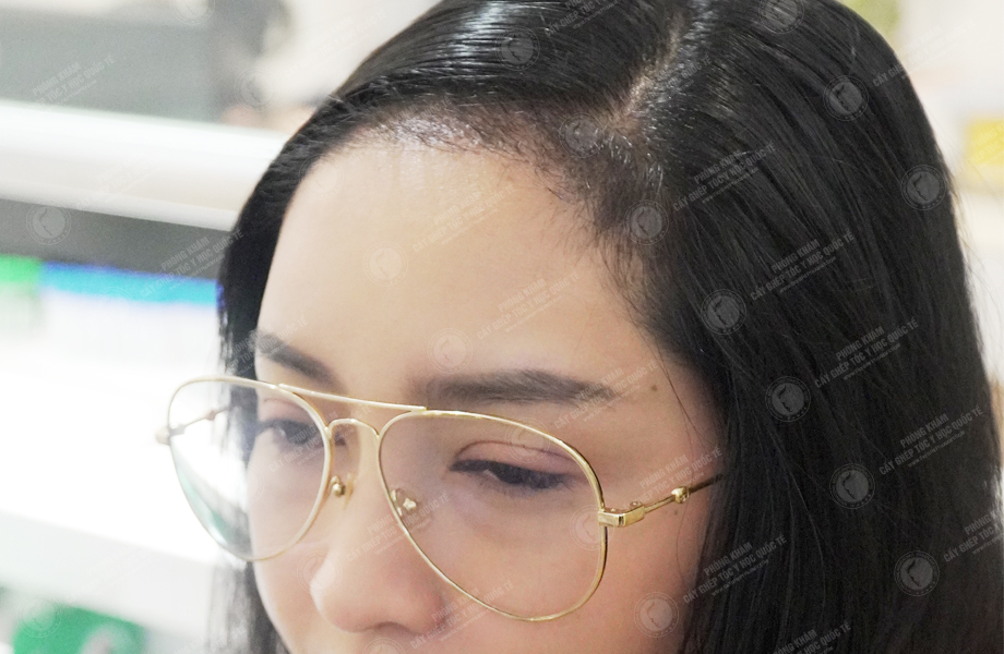Thu Trang - Cấy tóc đường chữ M 7