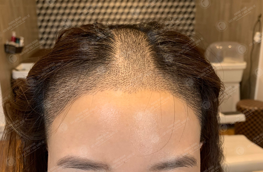Phạm Thu Nguyệt - Cấy tóc đường chữ M 7