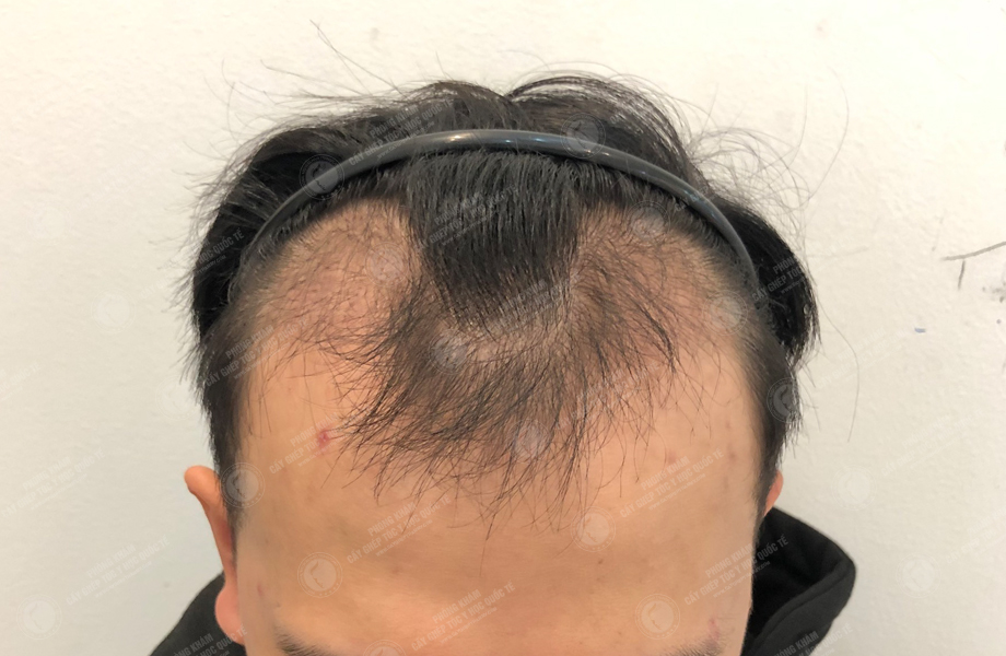 Nguyễn Thành Nam - Cấy tóc đường chữ M 7