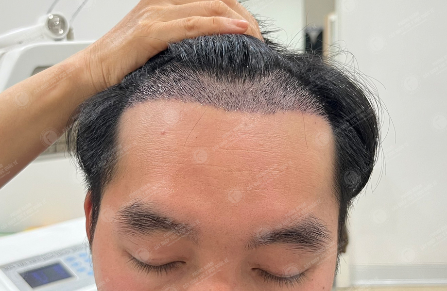 Phạm Trung Tuấn - Cấy tóc đường chữ M 7
