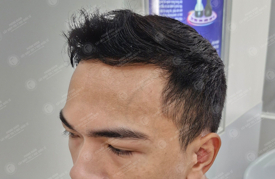 Trần Việt Dũng - Cấy tóc đường chữ M 7