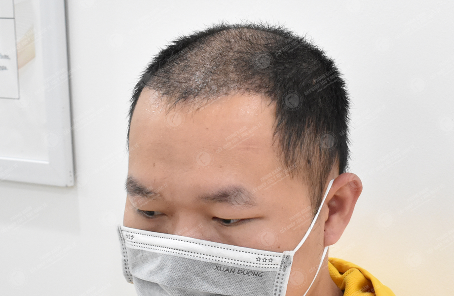 Trần Duy Tâm - Cấy tóc đường chữ M 7