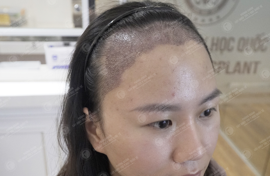 Nguyễn Thị Thúy Hằng - Cấy tóc đường chữ M 7