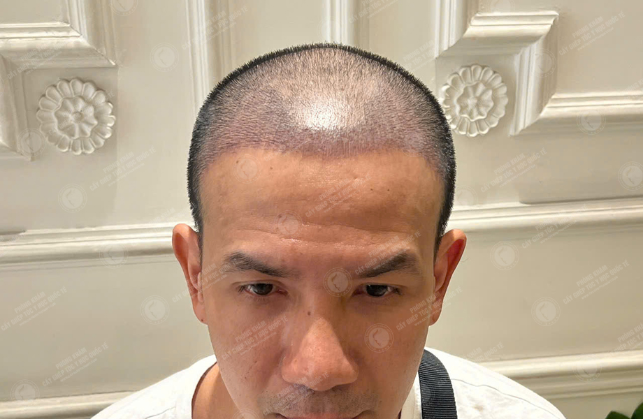 Nguyễn Hoàng Long - Cấy tóc đường chữ M 7