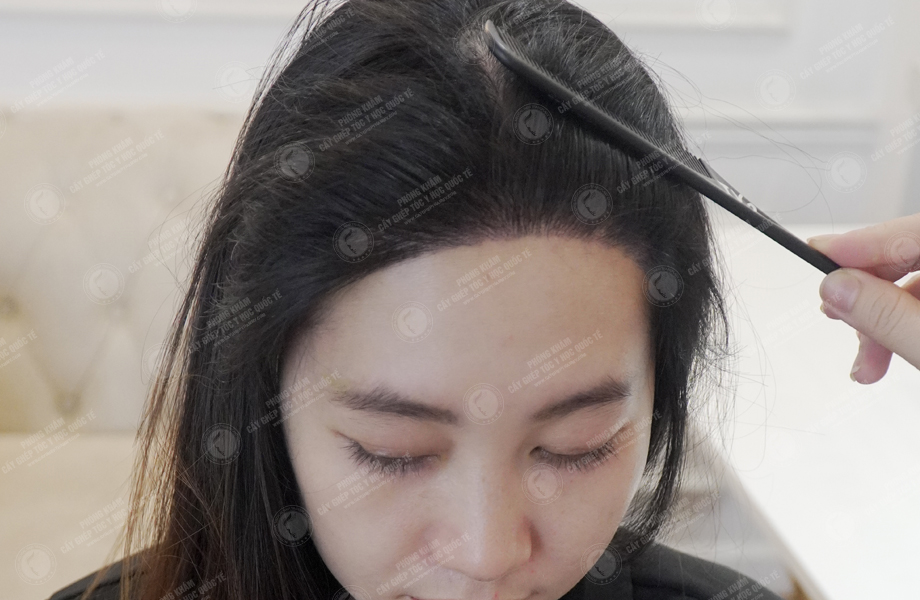 Phạm Thị Kim - Cấy tóc đường chữ M 7