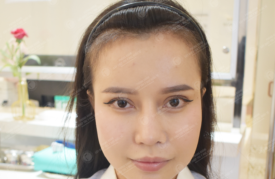 Nguyễn Thị Thảo - Cấy tóc đường chữ M 7