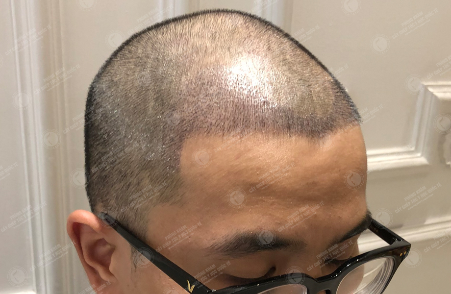 Hoàng Thanh Sơn - Cấy tóc đường chữ M 7
