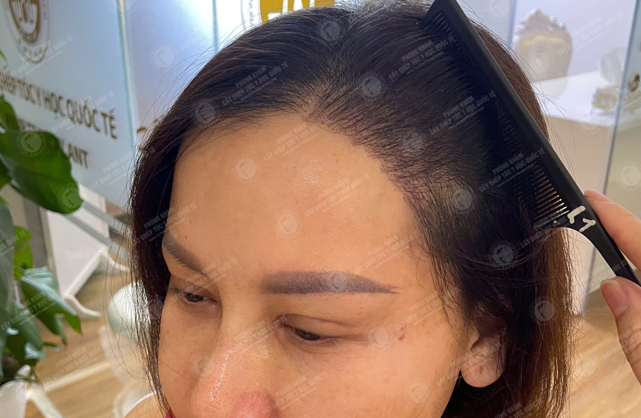 Ngô Thùy Dương - Cấy tóc đường chữ M 8
