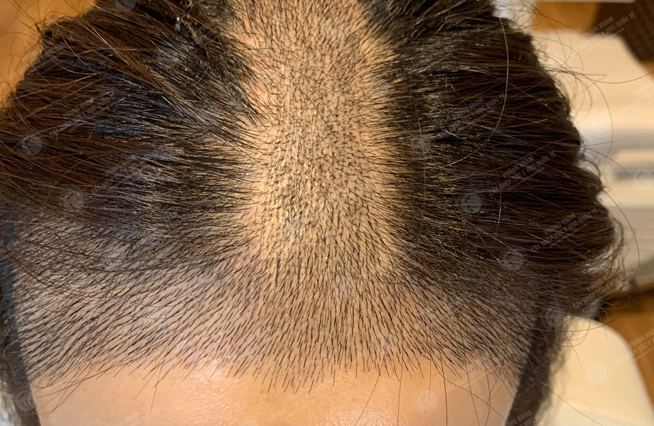 Phạm Thu Nguyệt - Cấy tóc đường chữ M 8