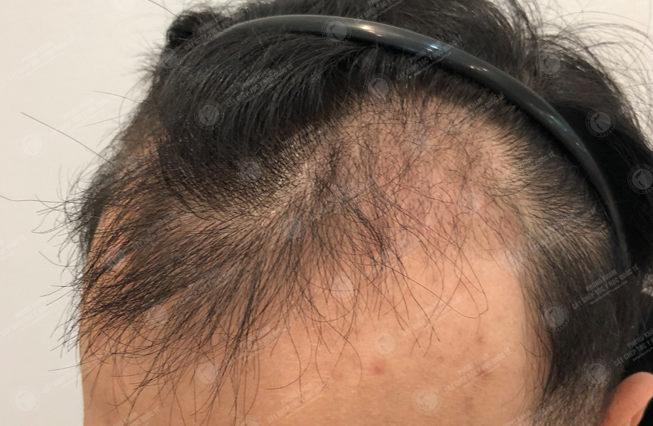 Nguyễn Thành Nam - Cấy tóc đường chữ M 8