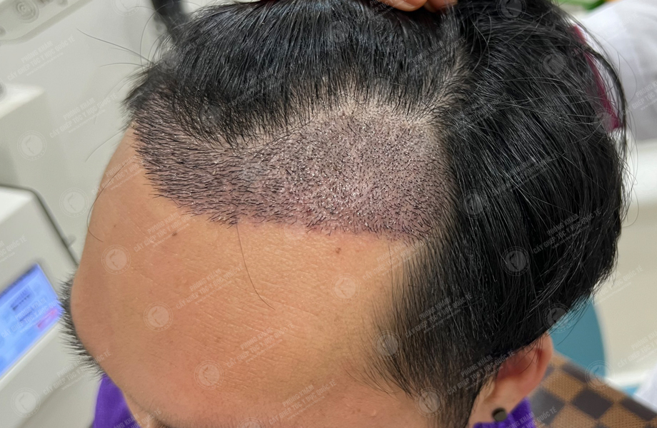 Phạm Trung Tuấn - Cấy tóc đường chữ M 8