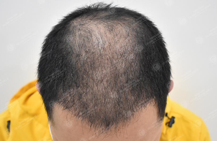 Trần Duy Tâm - Cấy tóc đường chữ M 8