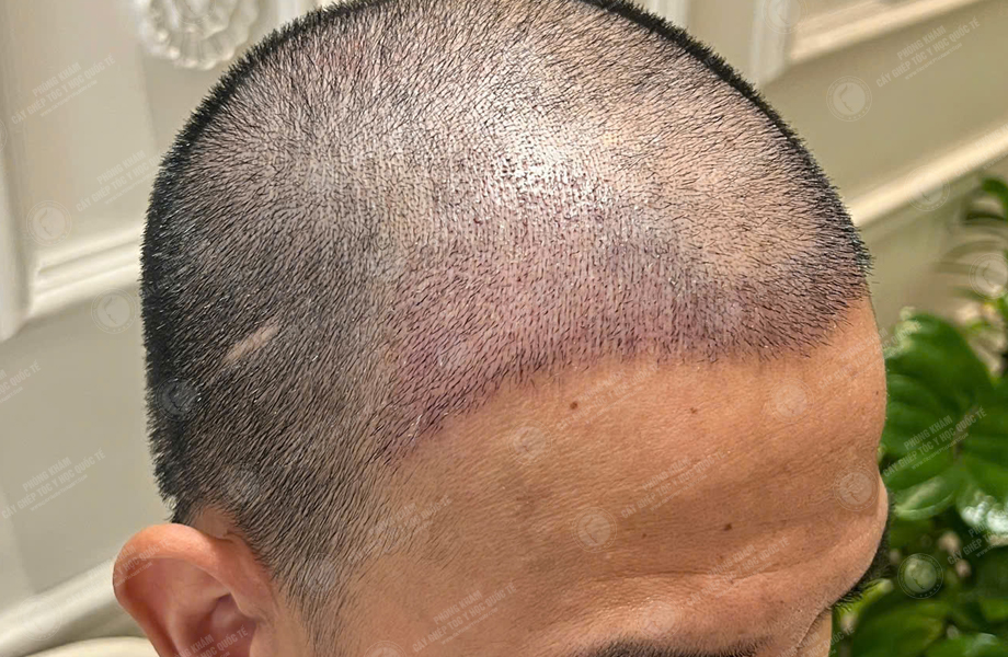 Nguyễn Hoàng Long - Cấy tóc đường chữ M 8