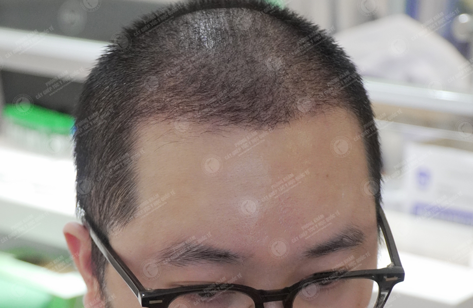 Nguyễn Thanh Tân - Cấy tóc đường chữ M 8