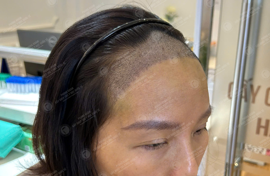 Phan Thị Tuyết - Cấy tóc đường chữ M 8
