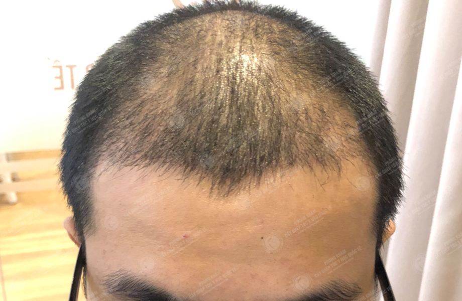Hoàng Thanh Sơn - Cấy tóc đường chữ M 8