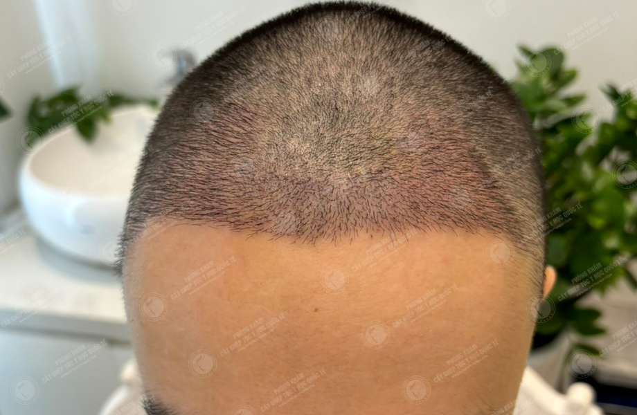 Phạm Trấn Thành - Cấy tóc đường chữ M 9