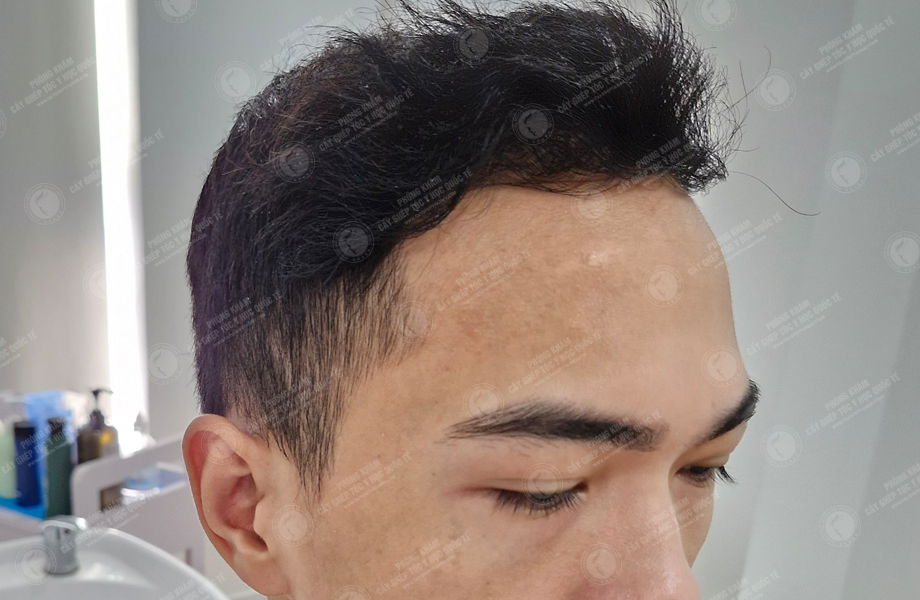 Trần Việt Dũng - Cấy tóc đường chữ M 9