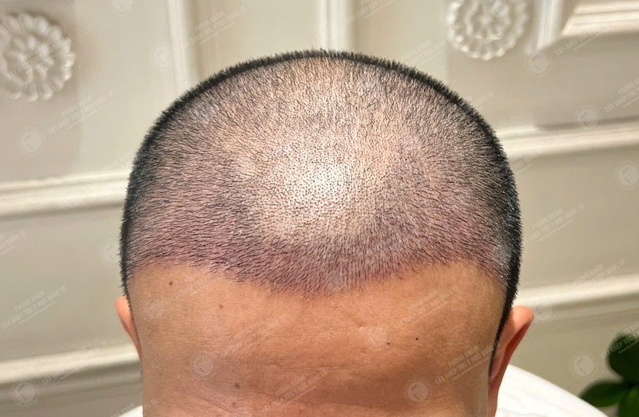 Nguyễn Hoàng Long - Cấy tóc đường chữ M 9