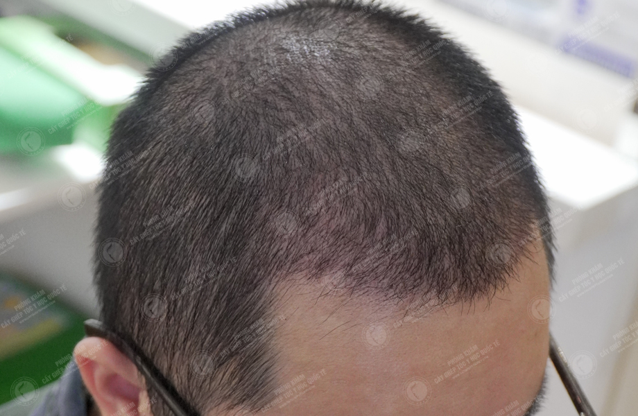 Nguyễn Thanh Tân - Cấy tóc đường chữ M 9