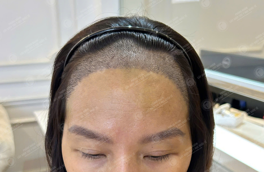 Phan Thị Tuyết - Cấy tóc đường chữ M 9