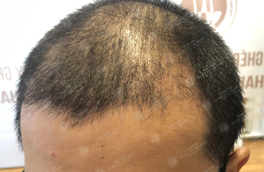 Hoàng Thanh Sơn - Cấy tóc đường chữ M 9