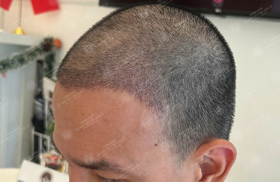 Nguyễn Hoàng Long - Cấy tóc đường chữ M 10
