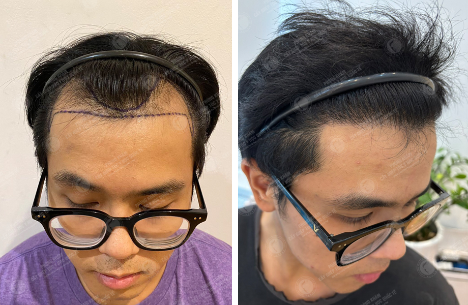  Hoàng Thanh Sơn - Cấy tóc đường chữ M 1