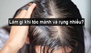 Làm gì khi tóc mảnh và rụng nhiều? Lời khuyên từ bác sĩ chuyên khoa