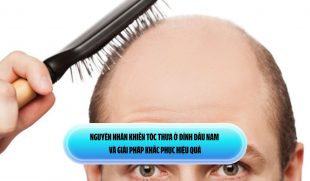 Nguyên nhân khiến tóc thưa ở đỉnh đầu nam và giải pháp khắc phục hiệu quả