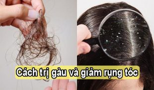 Tổng hợp những cách trị gàu và giảm rụng tóc hiệu quả
