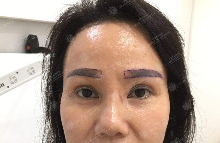 Vũ Ngọc Huyền - Cấy lông mày 2